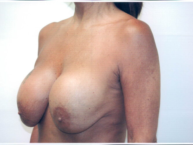 Breast Reduction Patient 08 - Before - 1