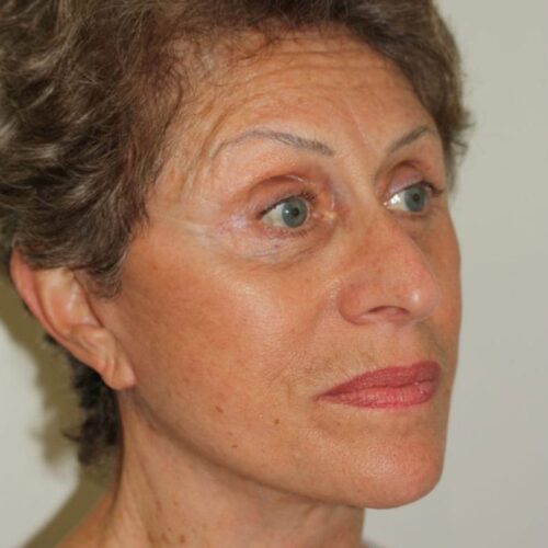 Female Facelift Patient 03 - After - 2