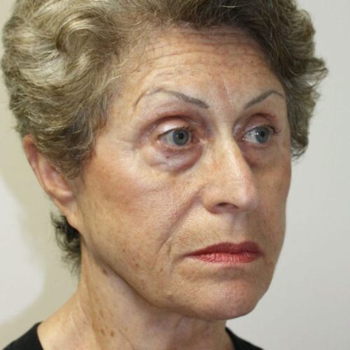 Female Facelift Patient 03 - Before - 2