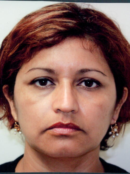 Female Facelift Patient 33 - Before - 1