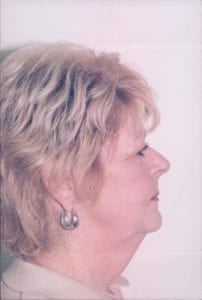 Female Facelift Patient 32 - Before - 2 Thumbnail