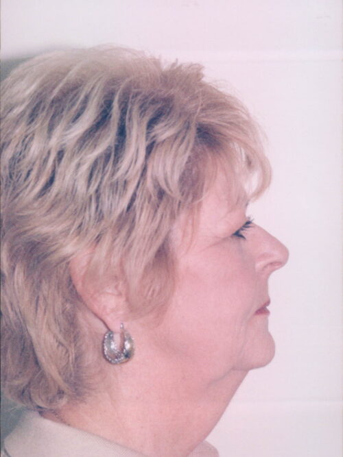 Female Facelift Patient 32 - Before - 2