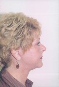 Female Facelift Patient 32 - After - 2 Thumbnail