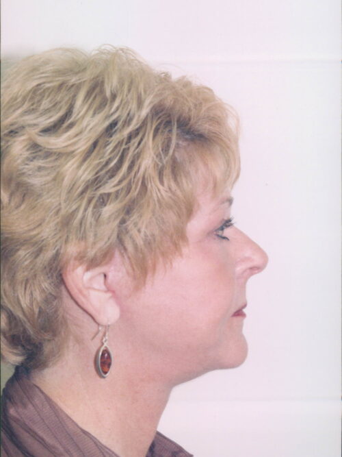 Female Facelift Patient 32 - After - 2