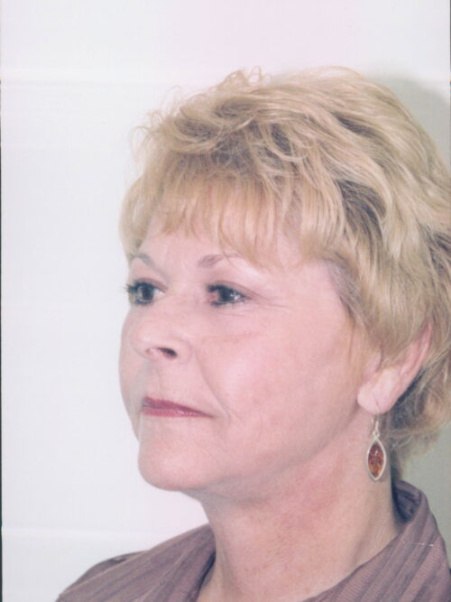 Female Facelift Patient 32 - After - 1