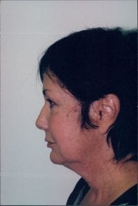 Female Facelift Patient 28 - Before - 1 Thumbnail