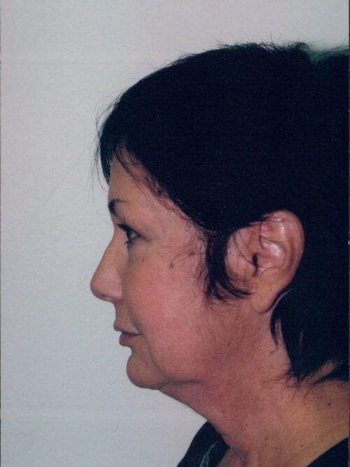 Female Facelift Patient 28 - Before - 1