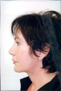 Female Facelift Patient 28 - After - 1 Thumbnail