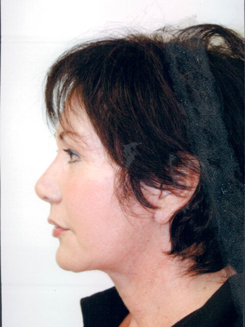 Female Facelift Patient 28 - After - 1