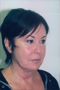 Female Facelift Patient 28 - Before - 2 Thumbnail