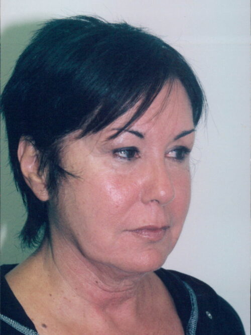 Female Facelift Patient 28 - Before - 2