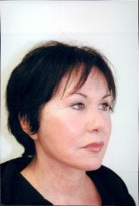 Female Facelift Patient 28 - After - 2 Thumbnail