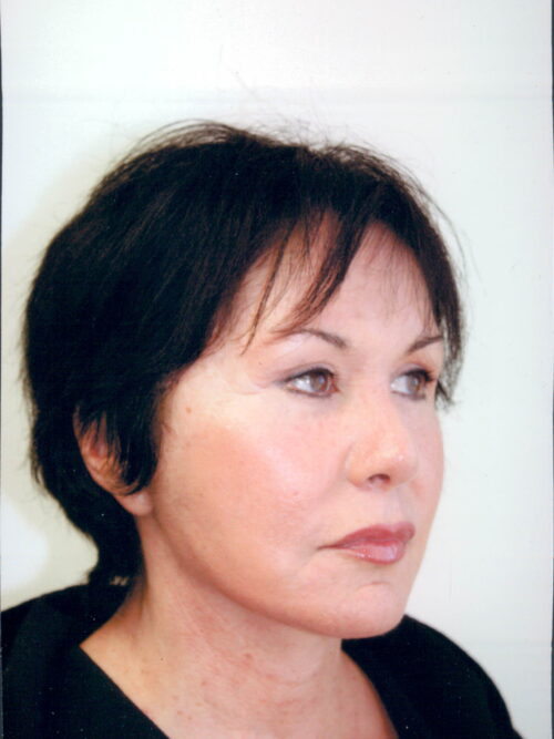 Female Facelift Patient 28 - After - 2