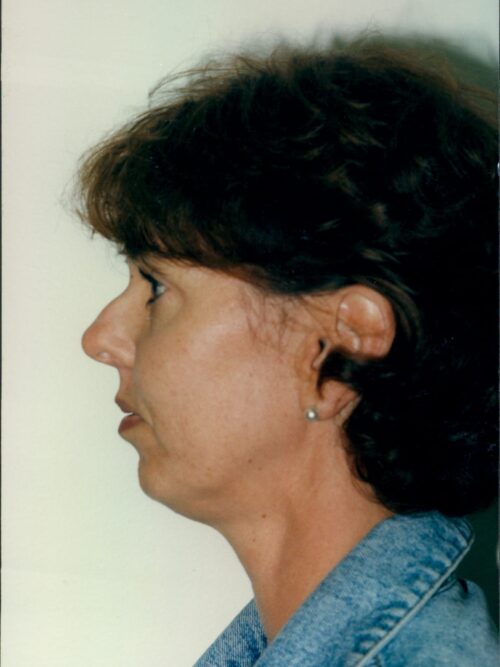 Female Facelift Patient 09 - Before - 1