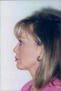 Female Facelift Patient 42 - After - 2 Thumbnail