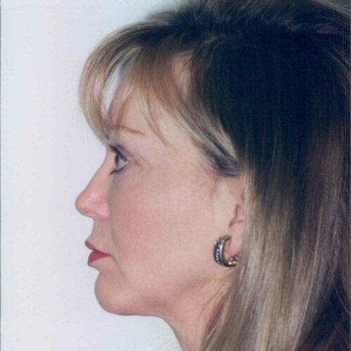 Female Facelift Patient 42 - After - 2