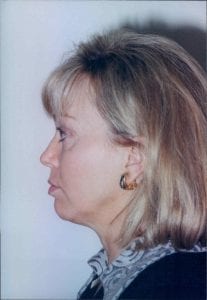 Female Facelift Patient 42 - Before - 2 Thumbnail