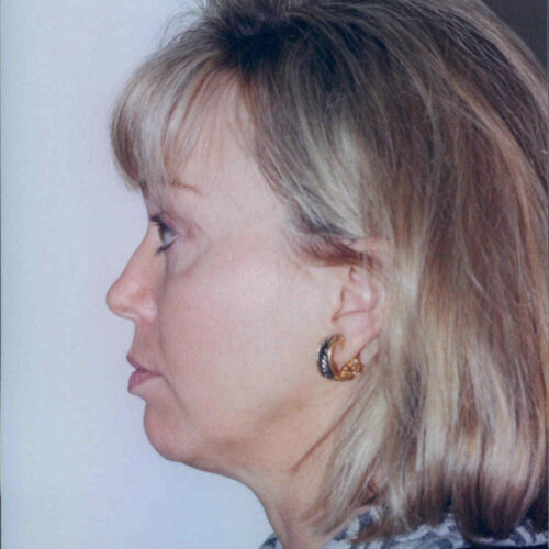 Female Facelift Patient 42 - Before - 2