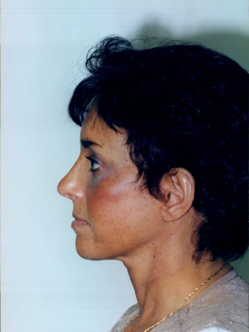 Female Facelift Patient 08 - After - 1