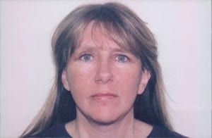 Female Facelift Patient 27 - After - 1 Thumbnail