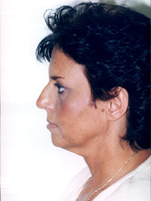 Female Facelift Patient 08 - Before - 1