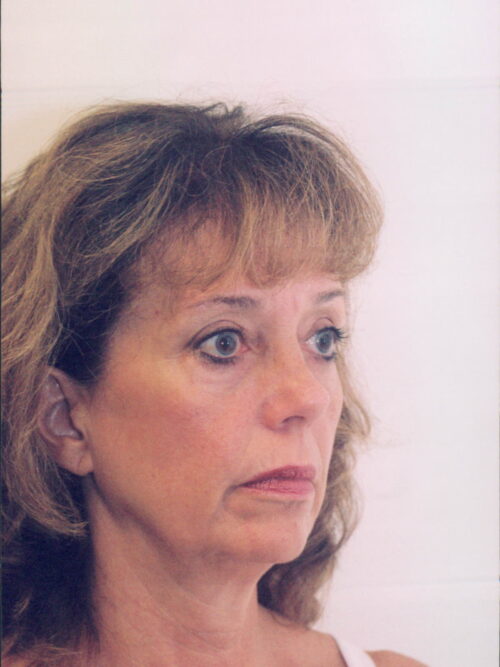 Female Facelift Patient 25 - Before - 3