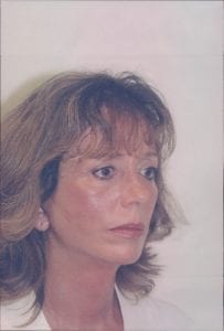 Female Facelift Patient 25 - After - 3 Thumbnail