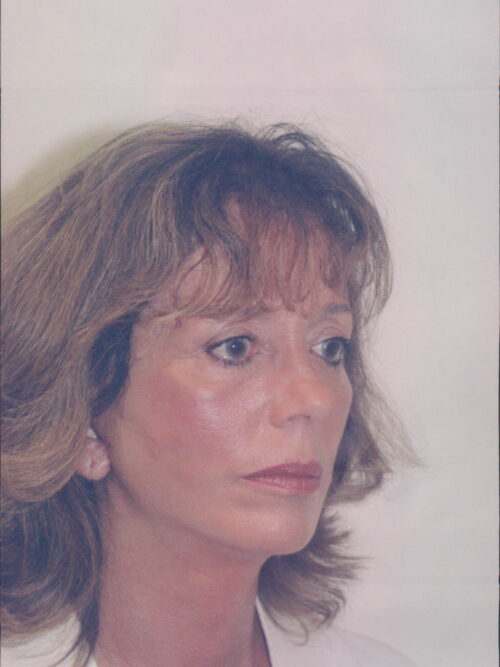 Female Facelift Patient 25 - After - 3