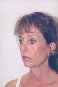 Female Facelift Patient 25 - Before - 2 Thumbnail