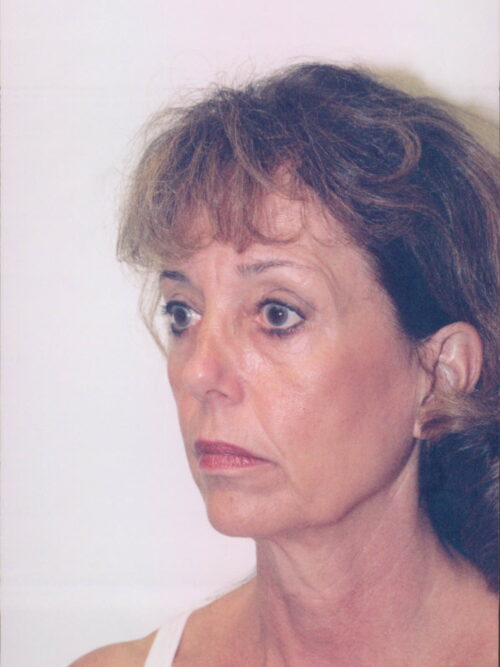 Female Facelift Patient 25 - Before - 2