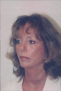 Female Facelift Patient 25 - After - 2 Thumbnail