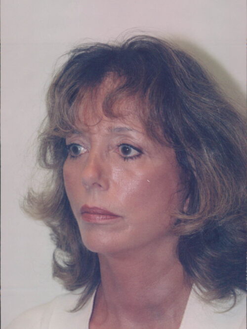 Female Facelift Patient 25 - After - 2