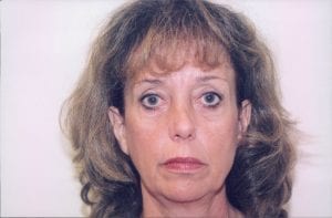 Female Facelift Patient 25 - Before - 1 Thumbnail