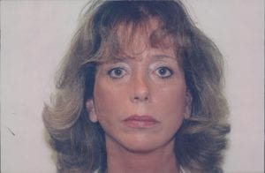 Female Facelift Patient 25 - After - 1 Thumbnail