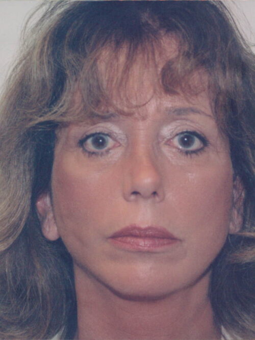 Female Facelift Patient 25 - After - 1