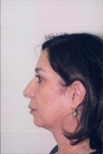 Female Facelift Patient 24 - Before - 2 Thumbnail