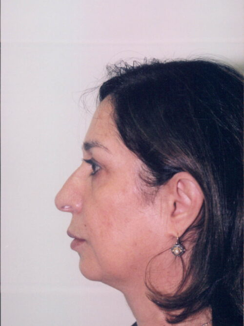 Female Facelift Patient 24 - Before - 2