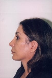 Female Facelift Patient 24 - After - 2 Thumbnail