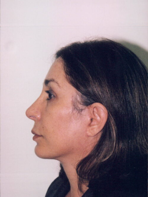 Female Facelift Patient 24 - After - 2