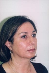 Female Facelift Patient 24 - Before - 1 Thumbnail