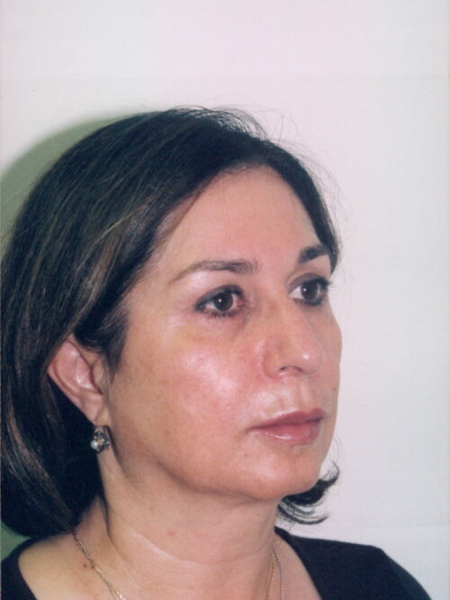 Female Facelift Patient 24 - Before - 1