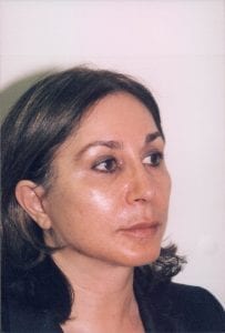 Female Facelift Patient 24 - After - 1 Thumbnail