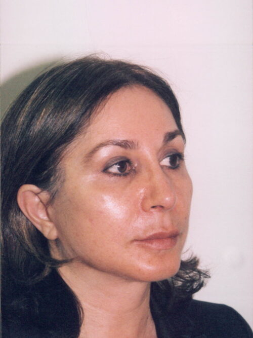 Female Facelift Patient 24 - After - 1