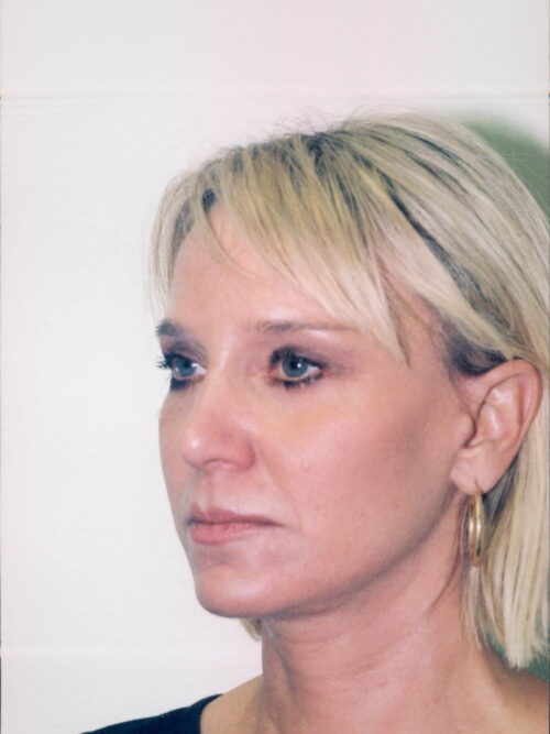 Female Facelift Patient 22 - After - 1