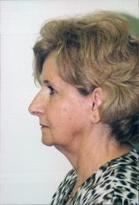 Female Facelift Patient 20 - Before - 2 Thumbnail