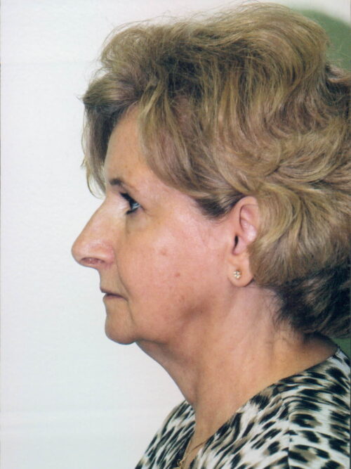 Female Facelift Patient 20 - Before - 2