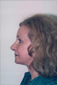 Female Facelift Patient 20 - After - 2 Thumbnail