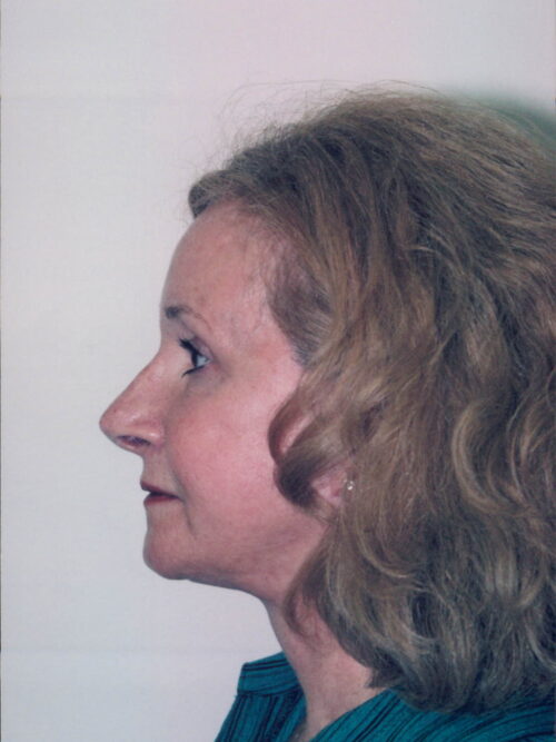 Female Facelift Patient 20 - After - 2