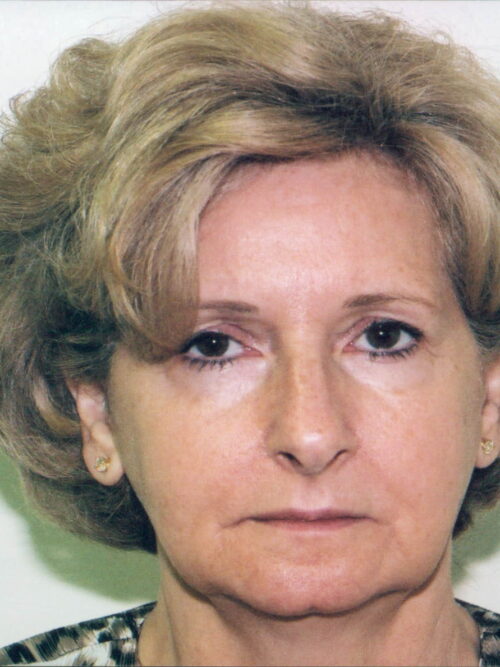 Female Facelift Patient 20 - Before - 1