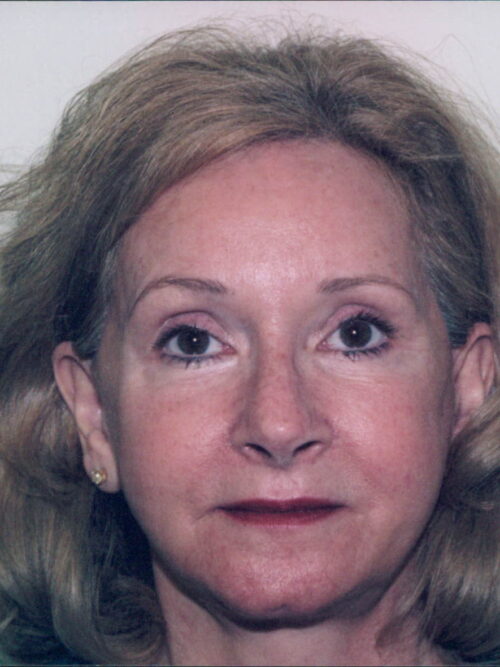 Female Facelift Patient 20 - After - 1